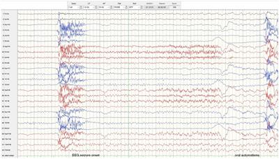 Seizure freedom without seizure medication following stereoelectroencephalography implantation: a case report of drug-resistant post-traumatic epilepsy